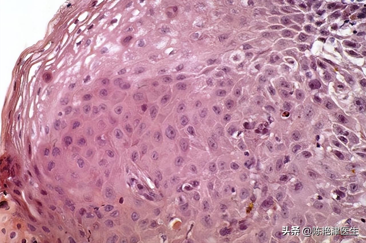 赵忠祥鳞状细胞癌早期症状,赵忠祥鳞状细胞癌有什么症状