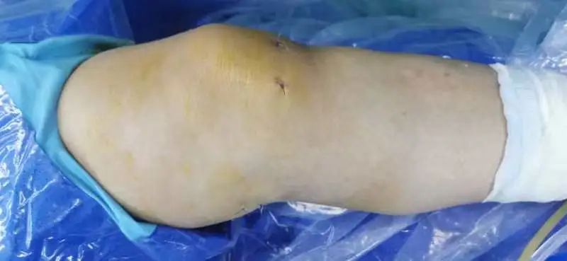 膝关节镜下囊肿切除术,关节镜微创腘窝囊肿切除