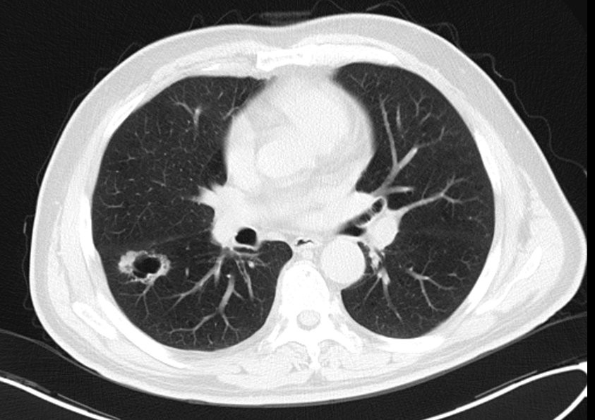 肺癌术后复发胸膜转移,肺癌术后复发转移还需要治疗吗