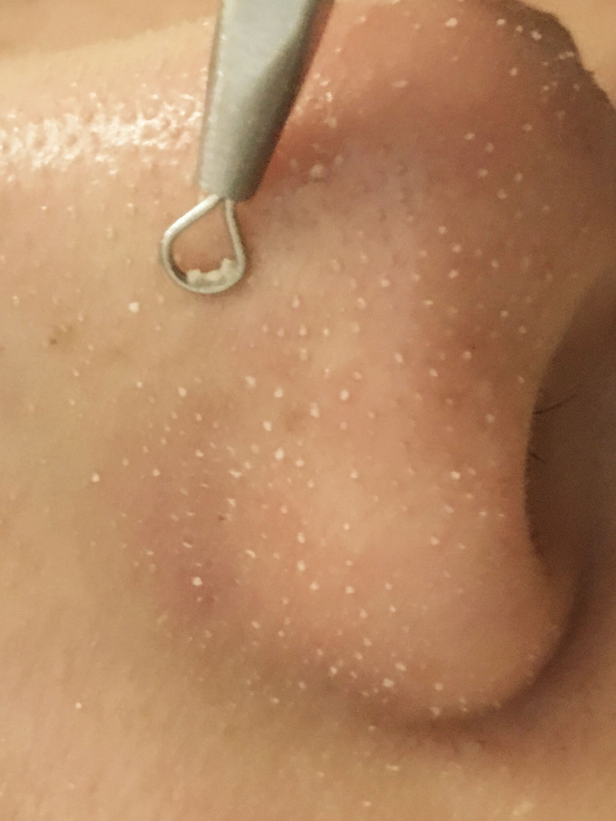 鼻子毛孔大能挤出好多脂肪粒,鼻子上长了像脂肪粒的东西