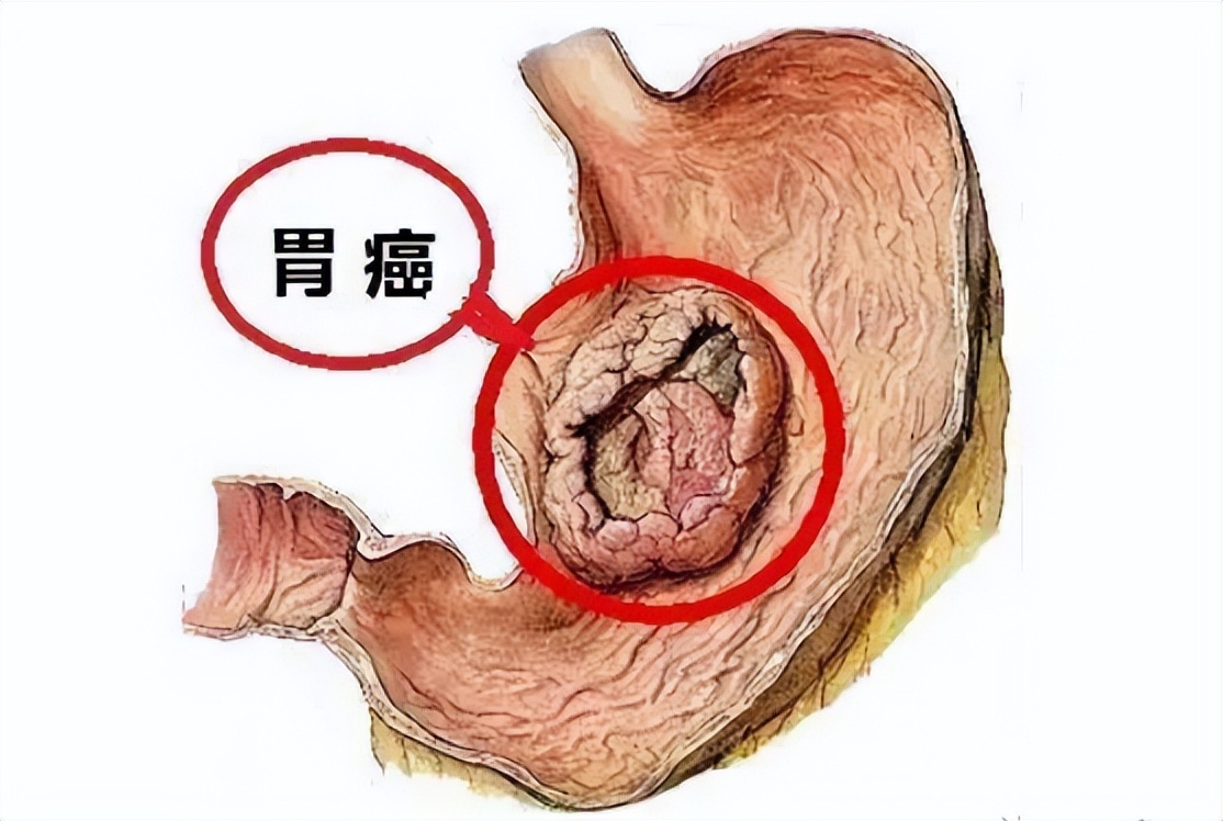 胃癌新辅助治疗的现状和挑战,2020年治疗晚期胃癌新技术