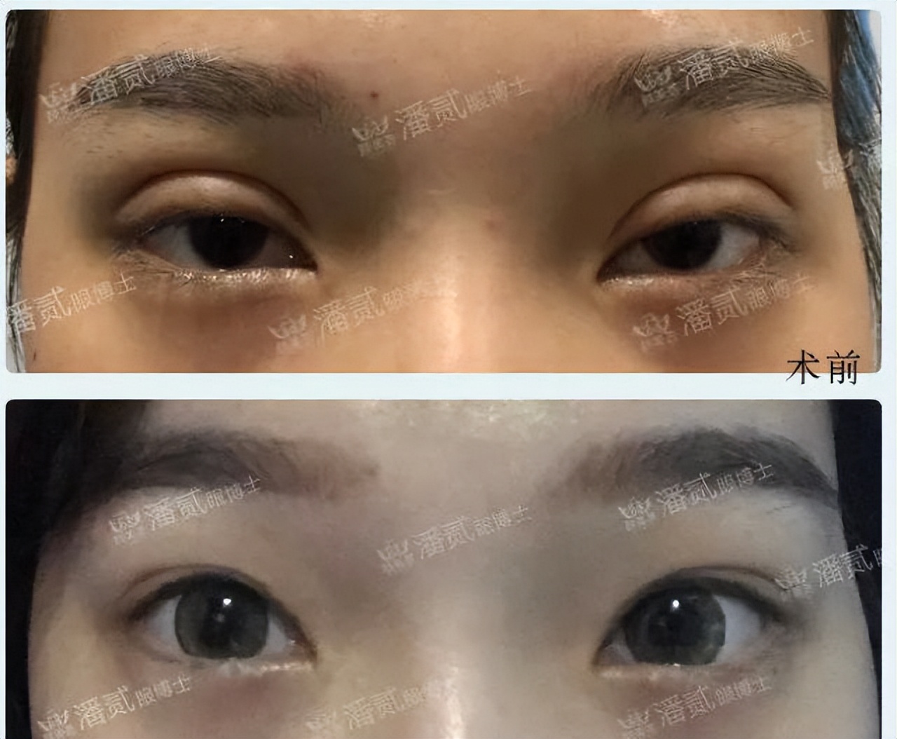 埋线双眼皮如果不满意怎么修复,切开双眼皮失败可以用埋线修复吗