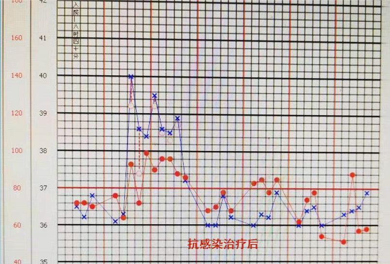 反复发烧但是拍片显示轻微肺炎,一直高烧39-40是肺炎么