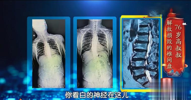 脊柱病三个动作自愈方法,椎间盘突出可以做脊柱屈的动作吗