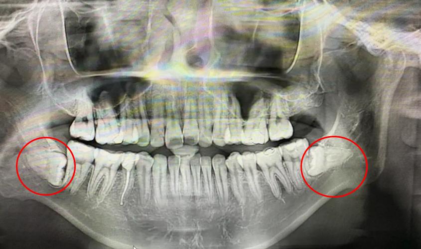 年龄越大凸嘴龅牙会不会越严重,年龄大了龅牙怎么办