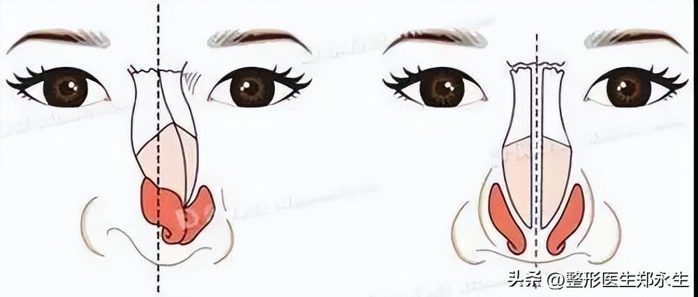 歪鼻是什么原因引起的,歪鼻歪鼻