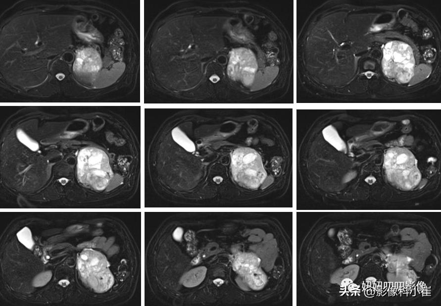 肾上腺疾病的诊断思路,肾上腺可能出现的病症有哪些