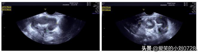 42岁左右女性输卵管炎怎么治疗好,女下腹疼痛伴有发烧37.5