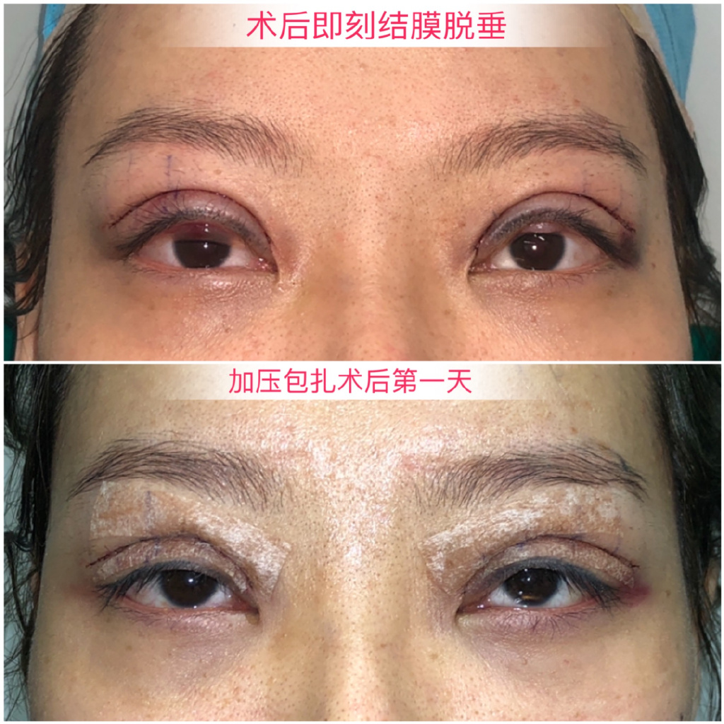 术后（重度上睑下垂）出现结膜脱垂怎么办？