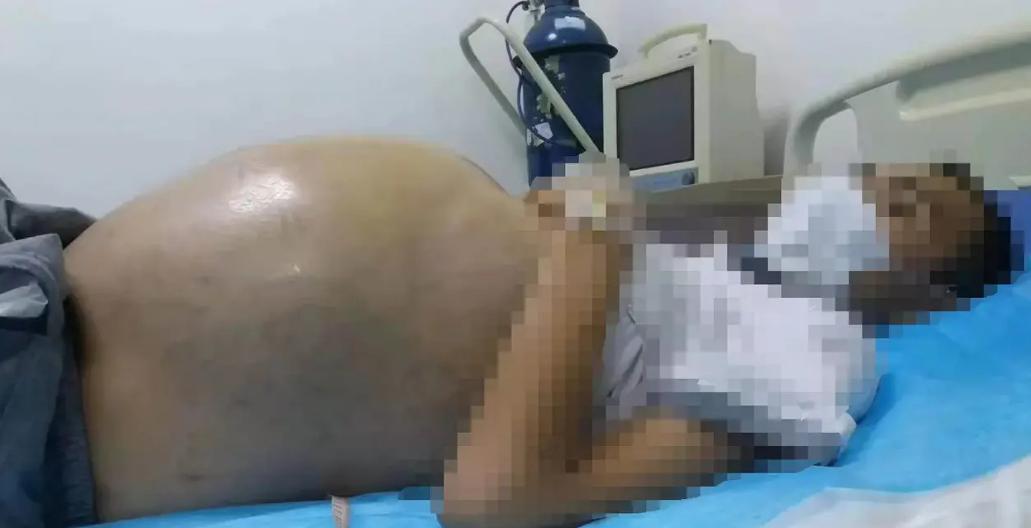 肝腹水治疗要谨慎，一味消水会把肾给消坏，最后人就没活头了