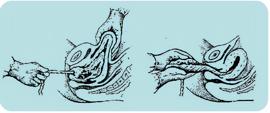胎儿屁股在右侧是什么胎位,胎位roa屁股在左边还是右边
