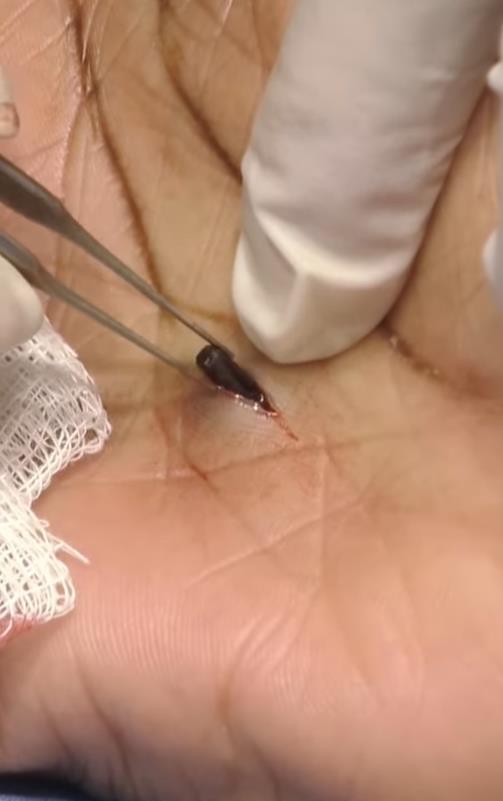 美国女子被橡皮子弹击中,女子手术取出戳20年铅笔芯