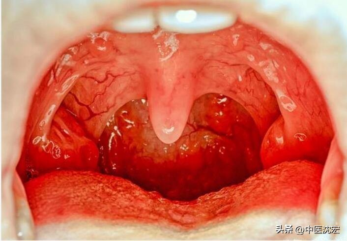 咽炎润肺化痰最快最有效方法,补肾润肺口服液治疗慢性咽炎吗
