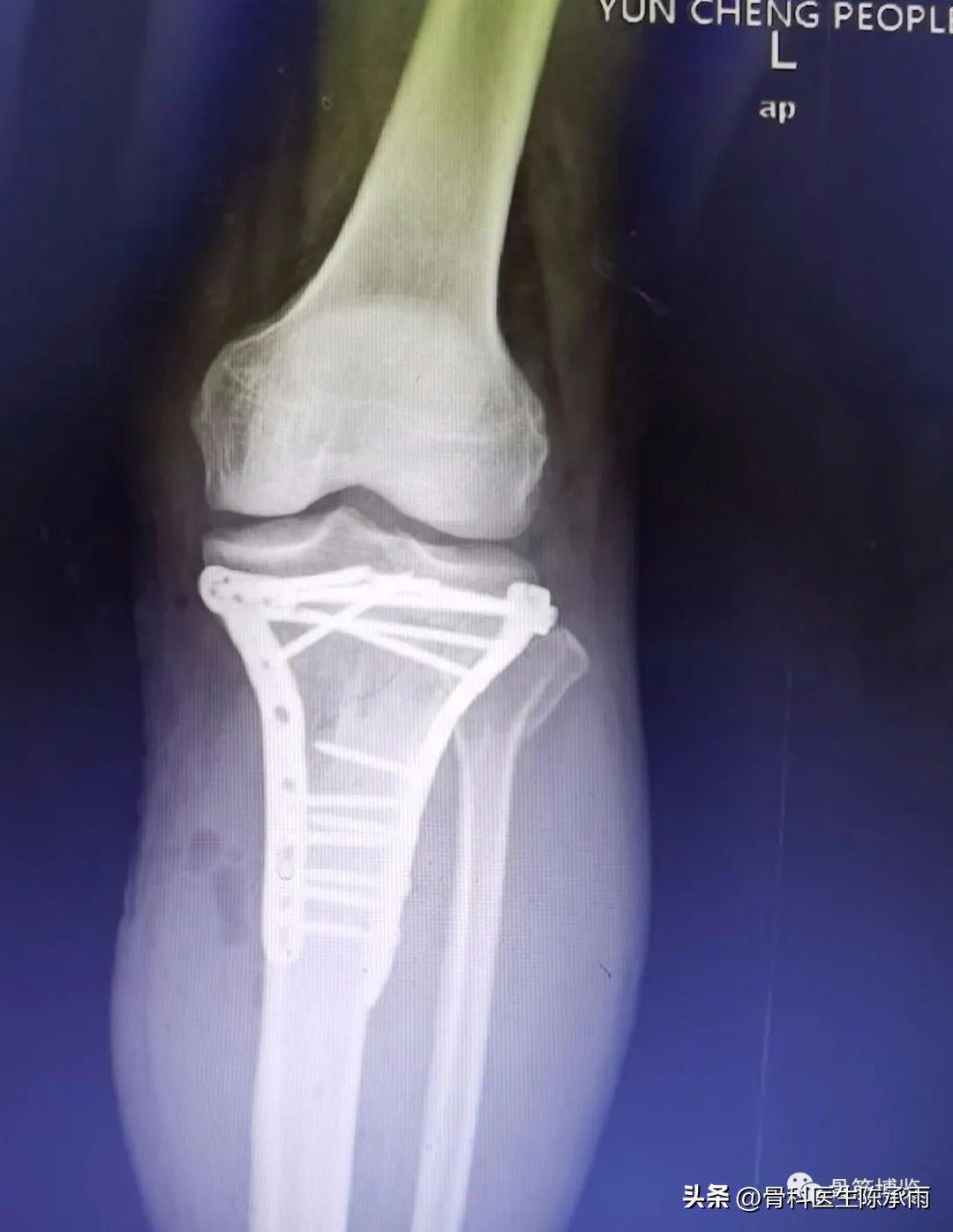 膝关节胫骨平台骨折,最近胫骨平台骨折视频