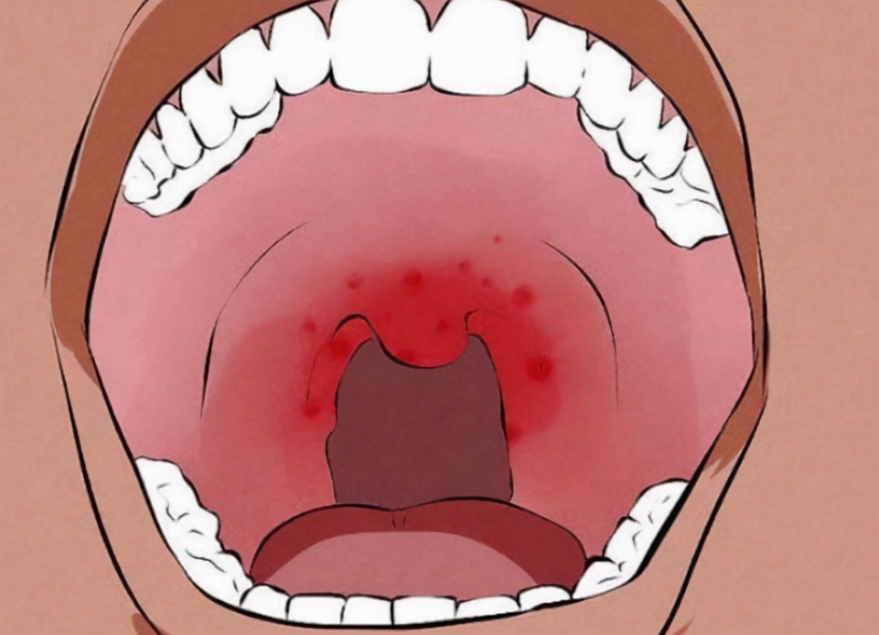 口腔癌早期症状是腮帮子酸牙有味,口腔癌早期治疗费用大概得多少钱