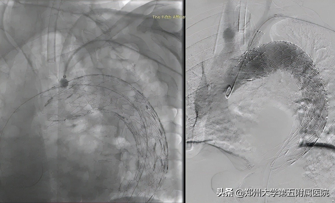 主动脉夹层血肿不消是怎么回事,主动脉壁间血肿血压不稳定
