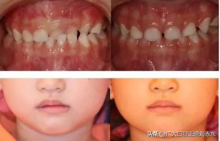 戴牙套可以改善牙齿歪吗,戴牙套可以改善脸歪嘴斜么