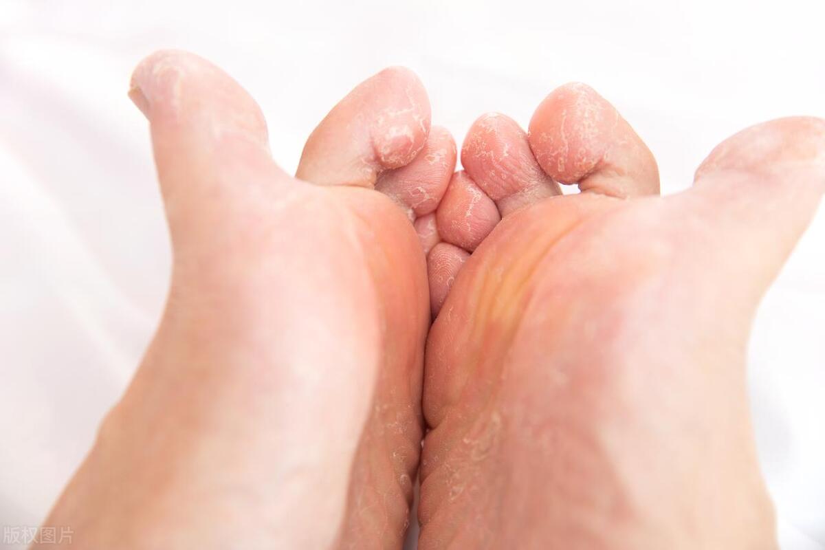 被脚气传染阴道炎,内裤和袜子同洗导致外阴真菌感染