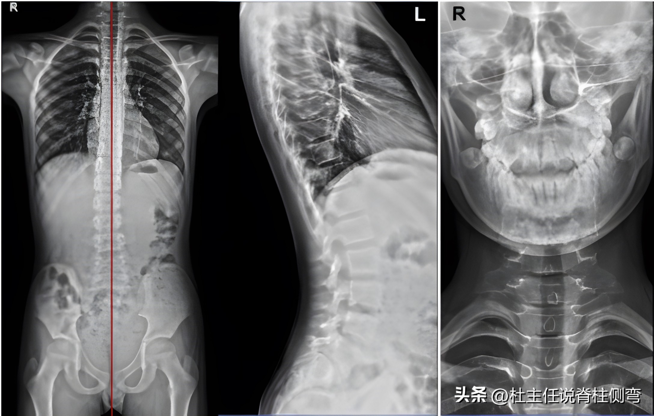 脊柱侧弯十几度有必要戴支具,17岁女孩脊柱侧弯需要佩戴支具吗