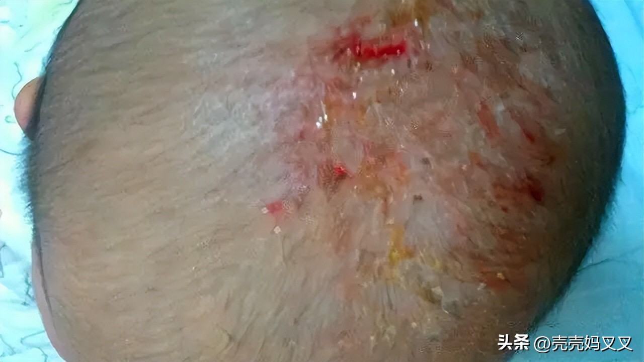 宝宝头皮奶痂用手抠了没事吧,千万不要用你的手去抠宝宝头垢