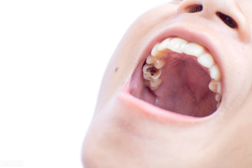 蛀牙疼痛怎么办最快止痛最有效,如何快速缓解蛀牙疼