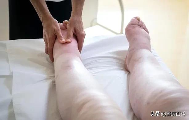 肌酐升高以后最怕肾友做3件事,肌酐升高怎么食疗