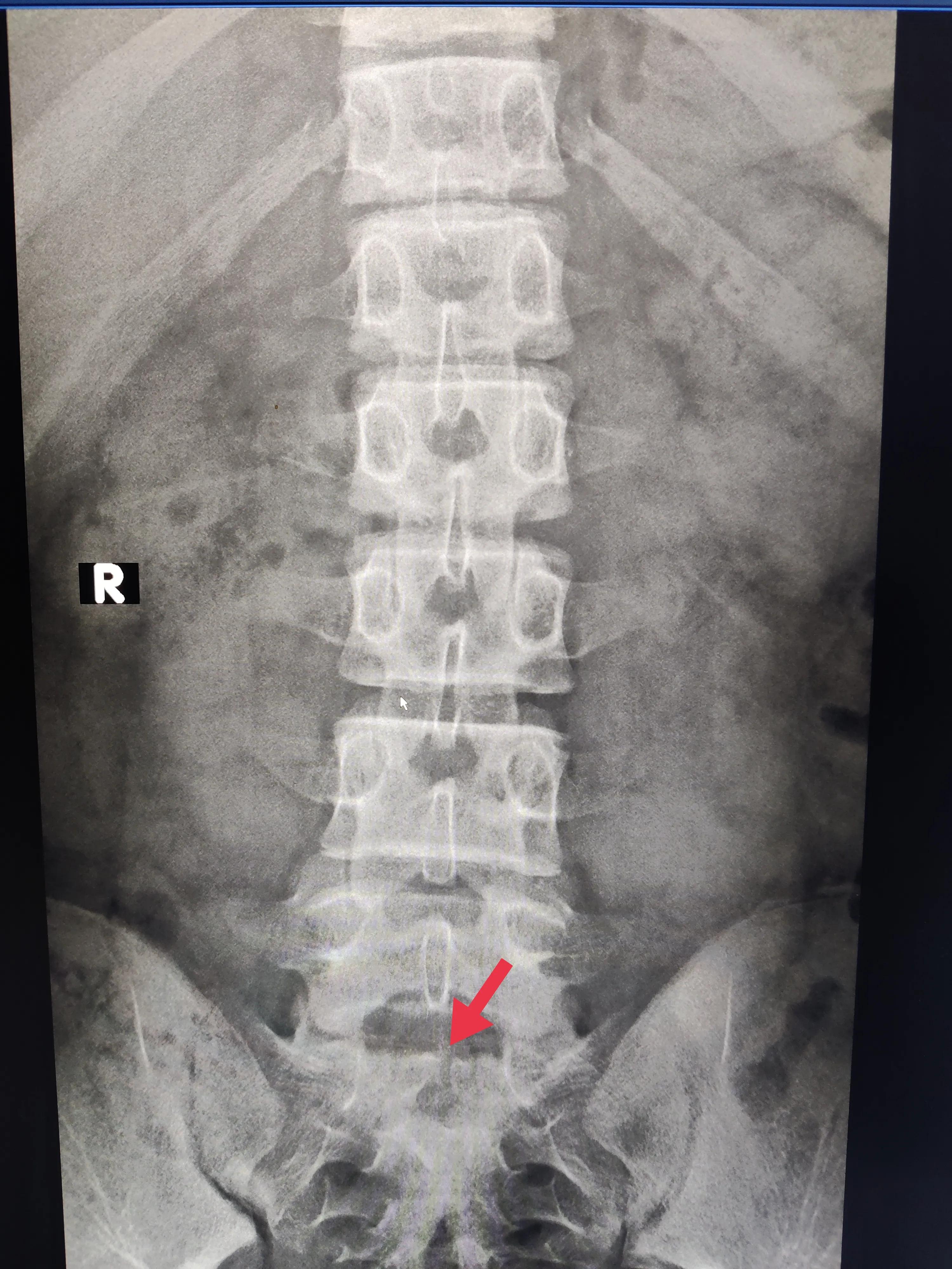 小朋友腰疼驼背怎么办,孩子弓腰驼背找哪科医生看