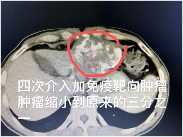 介入治疗原发性巨型肝癌有效吗,巨型肝癌介入加靶向药
