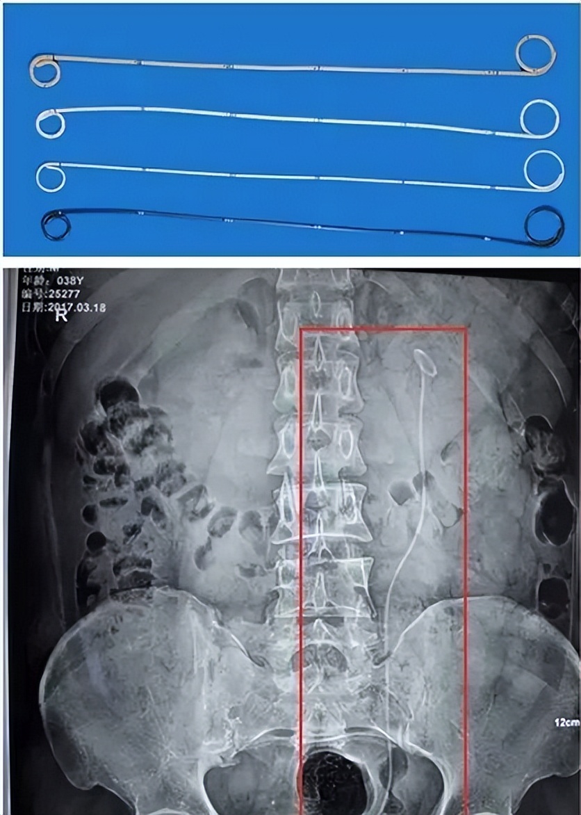 泌尿系结石术后护理查房,门诊输尿管结石微创术后注意事项