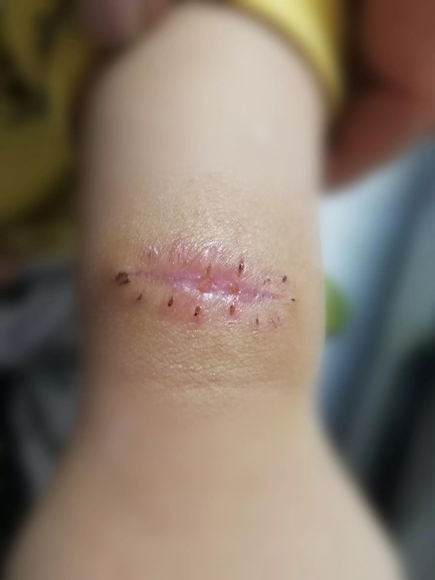 儿童黑毛痣术后图片,小孩黑毛痣切除一年恢复图片