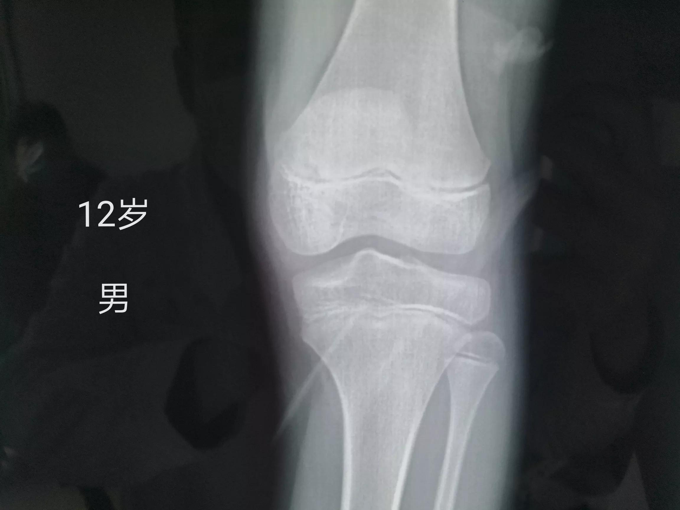 孩子膝盖疼和成长有关系吗,8岁孩子腿膝盖疼怎么回事