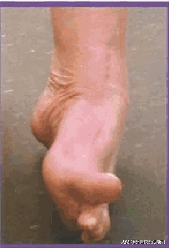 脑卒中足内翻还能恢复吗,足内翻针刺