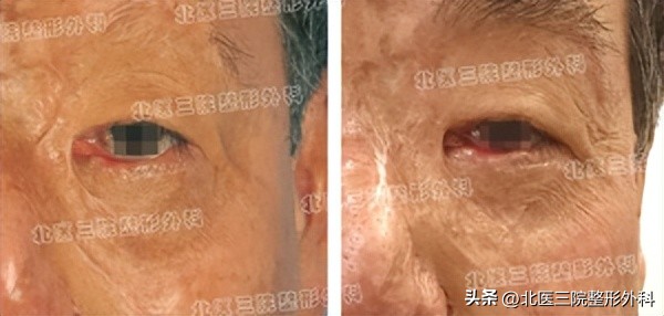 疤痕性眼睑外翻治疗方法,上眼睑疤痕性轻微外翻