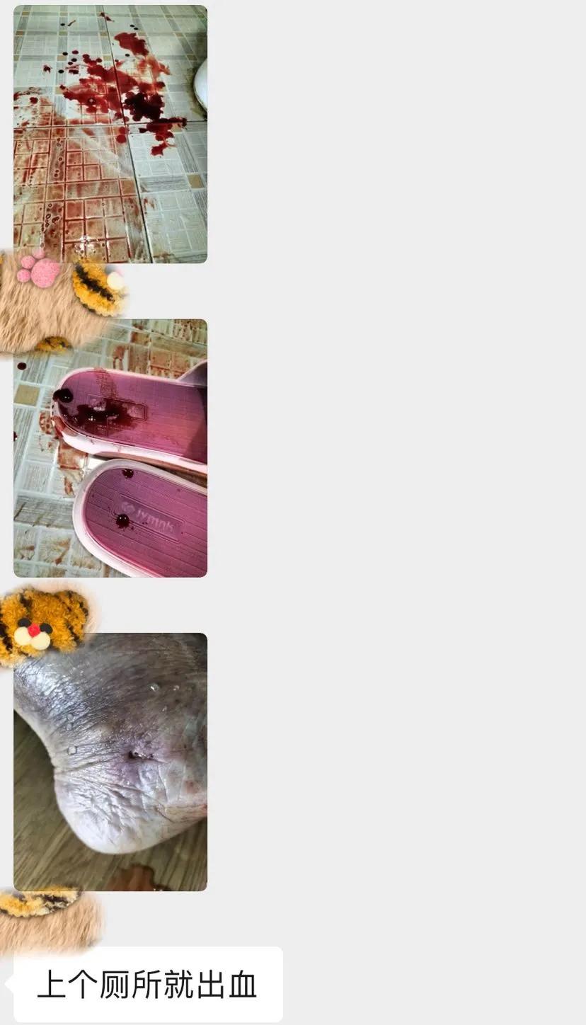 静脉曲张导致肺栓塞的案例,静脉曲张导致的血栓案例