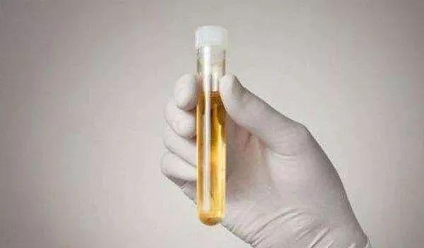 尿液发黄是不是身体有炎症,尿液发黄难闻什么原因