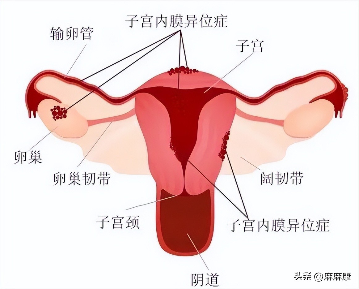 慢性盆腔炎的治疗方法,慢性盆腔疼痛哪治疗好