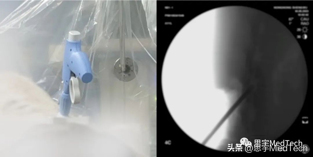 医疗器械公司奖励百万,微创医疗获1.5亿美元贷款