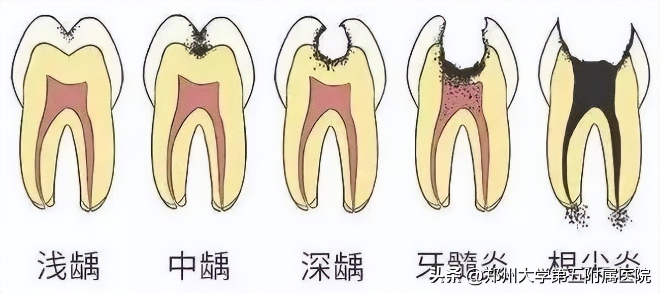 智齿蛀牙但是不痛,蛀牙不痛需要补吗