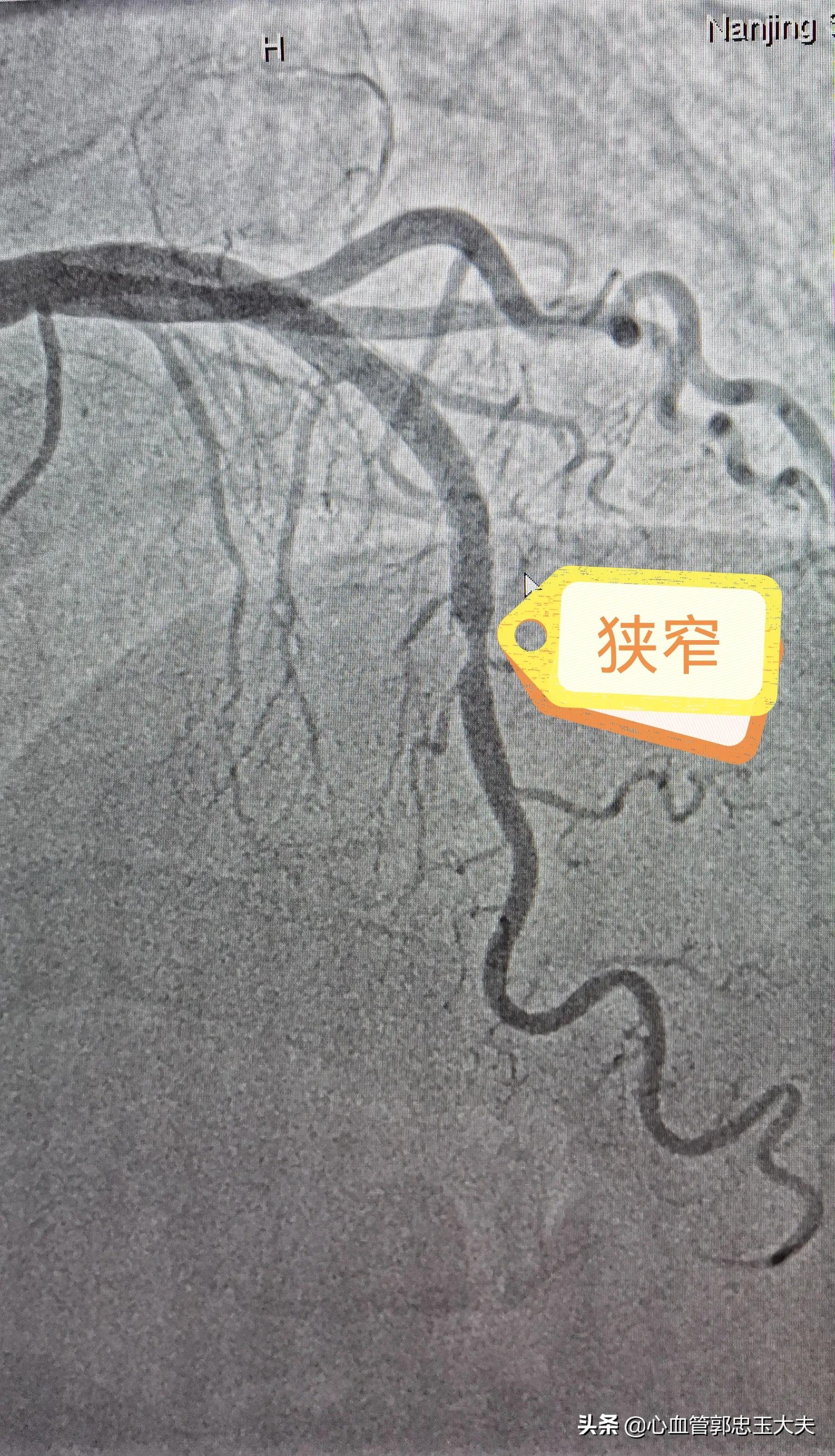 为什么支架内更容易堵,指标正常但支架内再狭窄