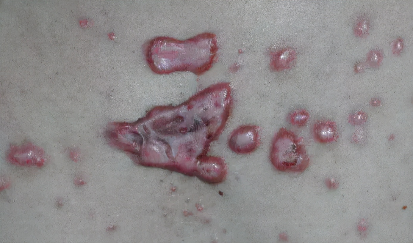 身上有疤就是疤痕体吗,疤痕体质疤痕疙瘩会变成癌症吗