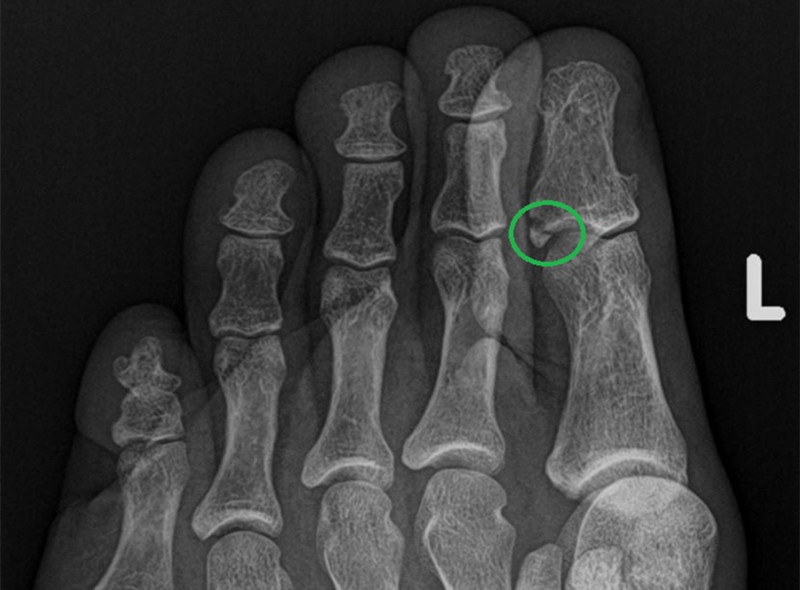 脚趾碰了一下怎么判断有没有骨折,脚趾扭伤怎么判断有没有伤到骨头