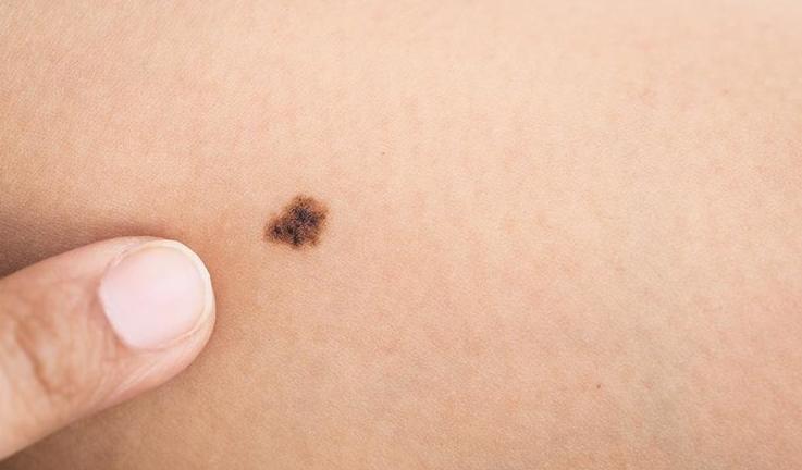 痣提前弄掉会导致黑色素瘤吗,痣和黑色素瘤哪个可以抠掉