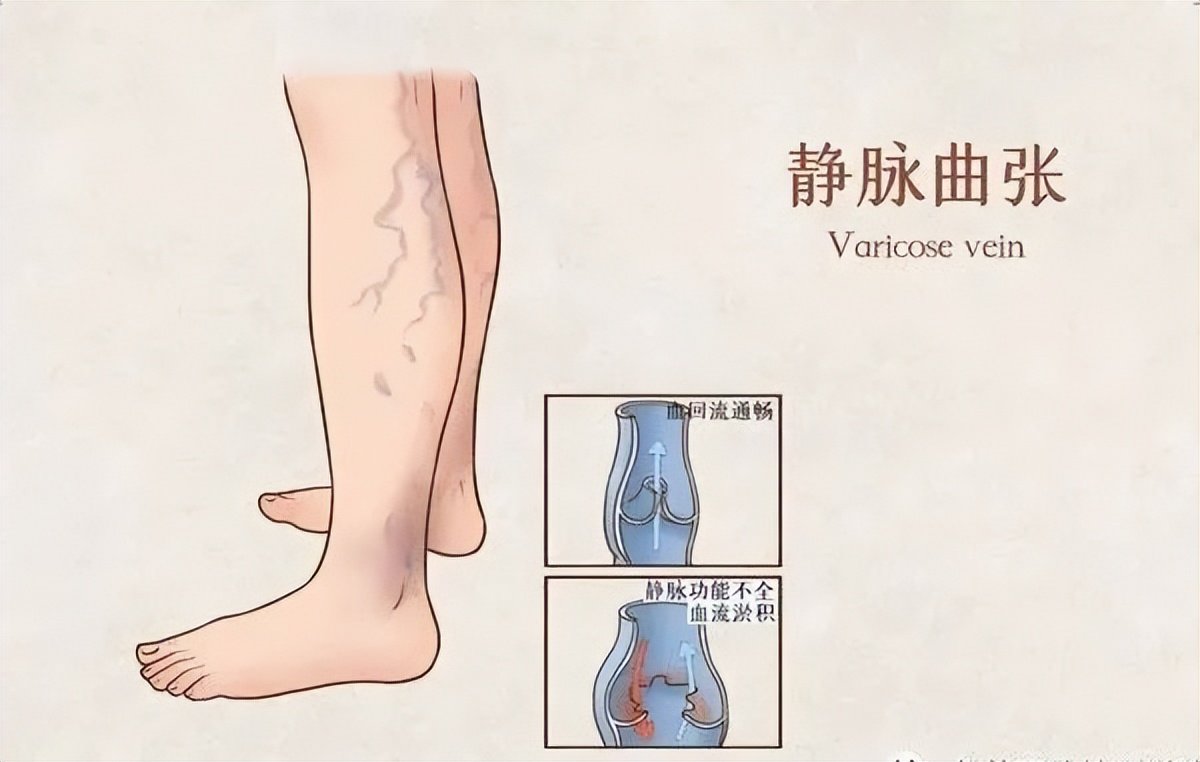 蚯蚓腿最怕什么药,如何防治蚯蚓腿