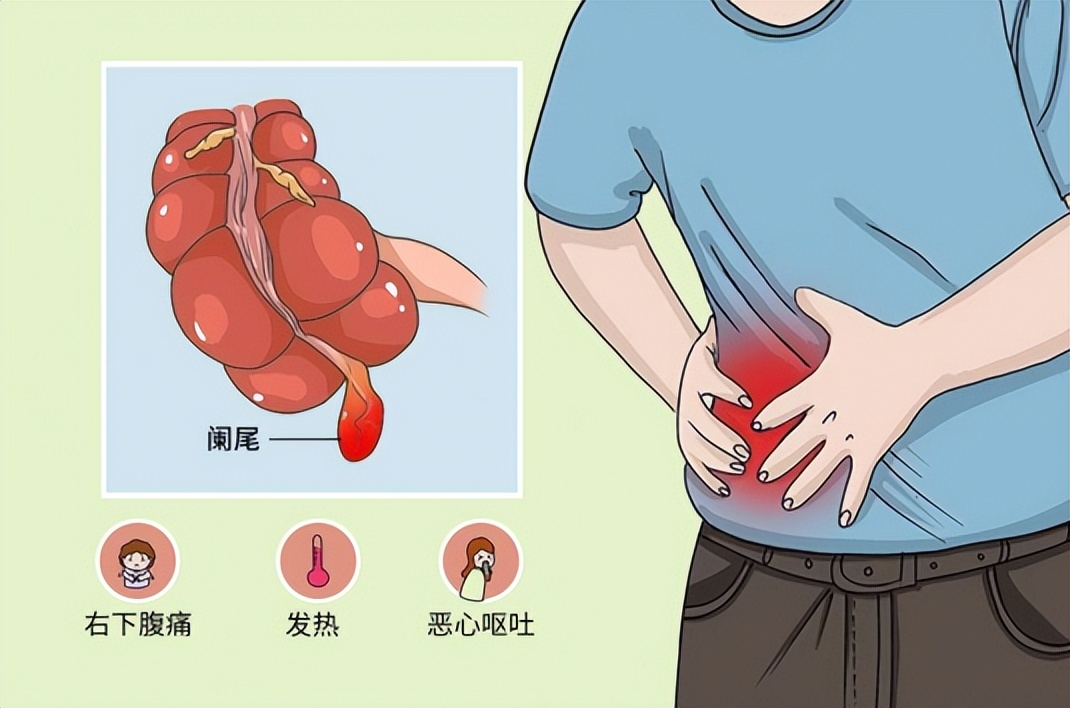 阑尾炎有什么症状表现在什么位置,阑尾炎的位置症状表现和治疗方法