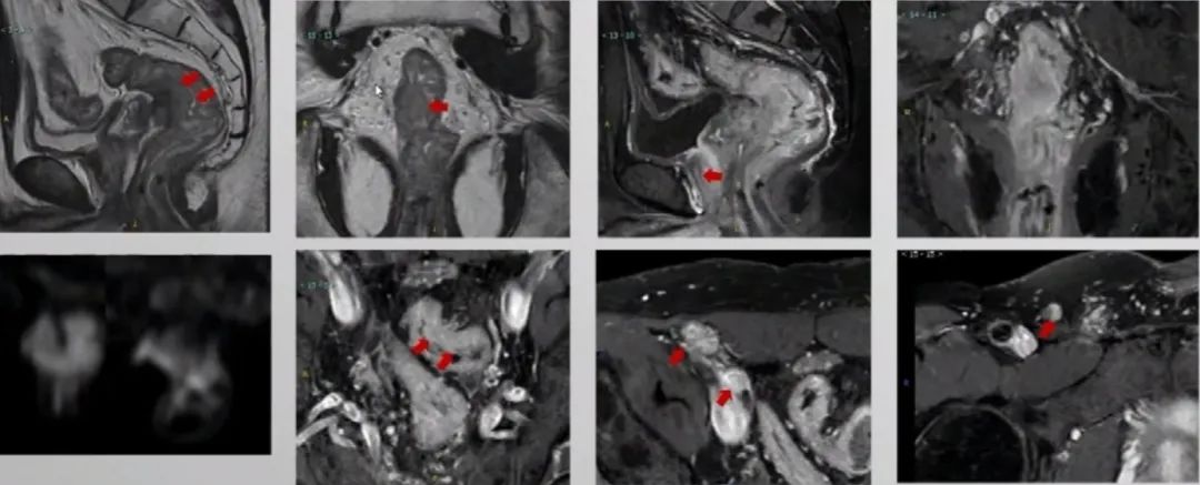 多原发癌症转移,多原发直肠癌