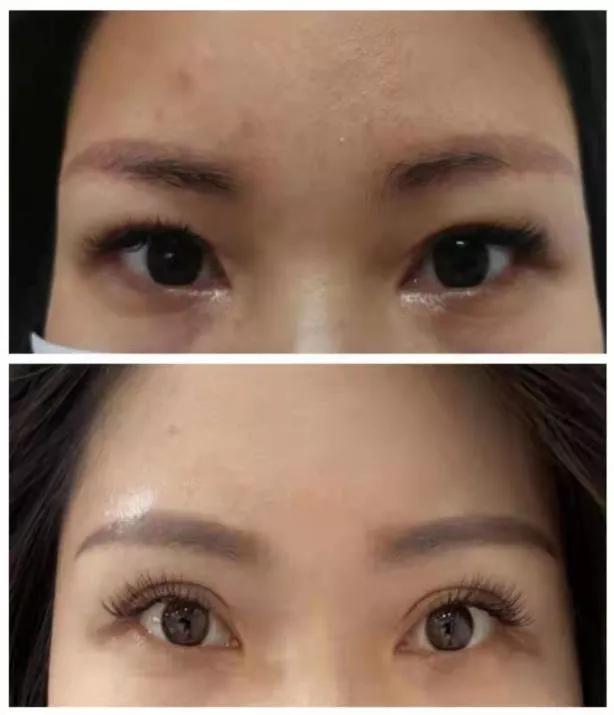 想割双眼皮怕失败,割双眼皮踩雷了应该找医院吗