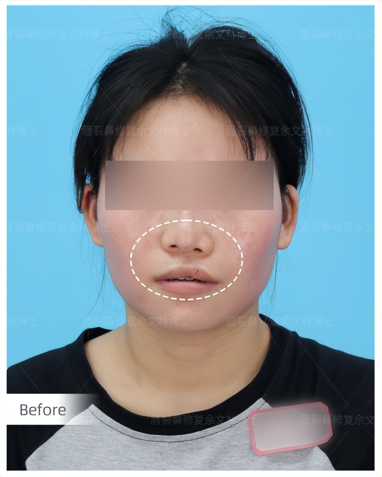 天生歪脖可以矫正吗,天生歪嘴能治好吗成人