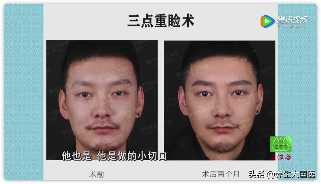 适合做双眼皮的手术有哪些,现在做双眼皮手术什么方法最先进