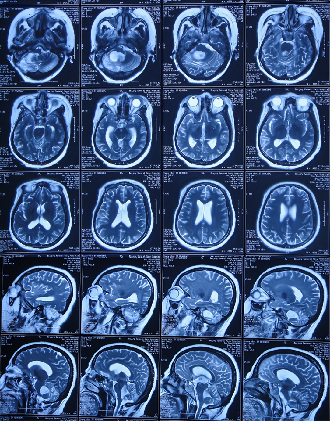 听神经瘤出现脑积水和出血,听神经瘤手术后颅压高症状