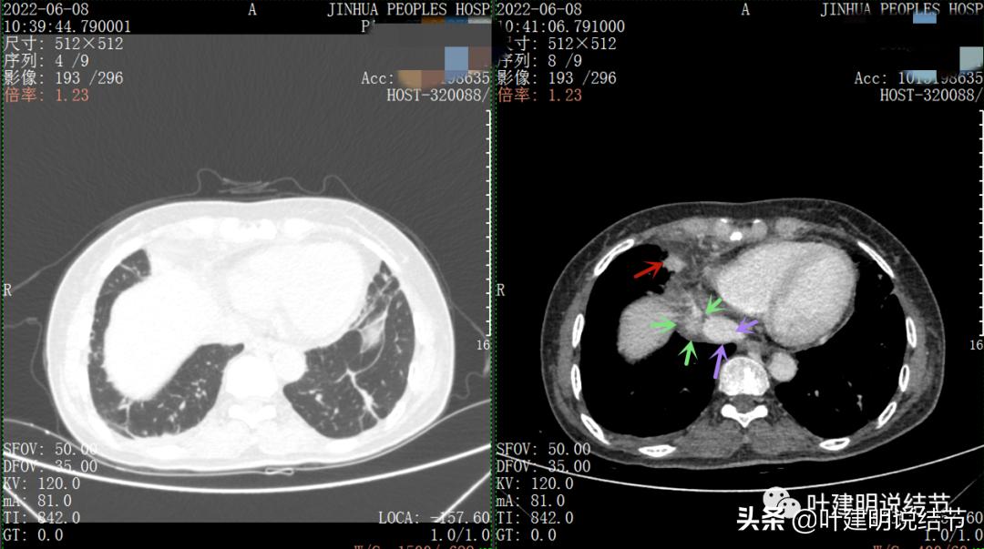 这位老乡，乏力来查，查出这么大个的纵隔肿瘤！会是什么呢？